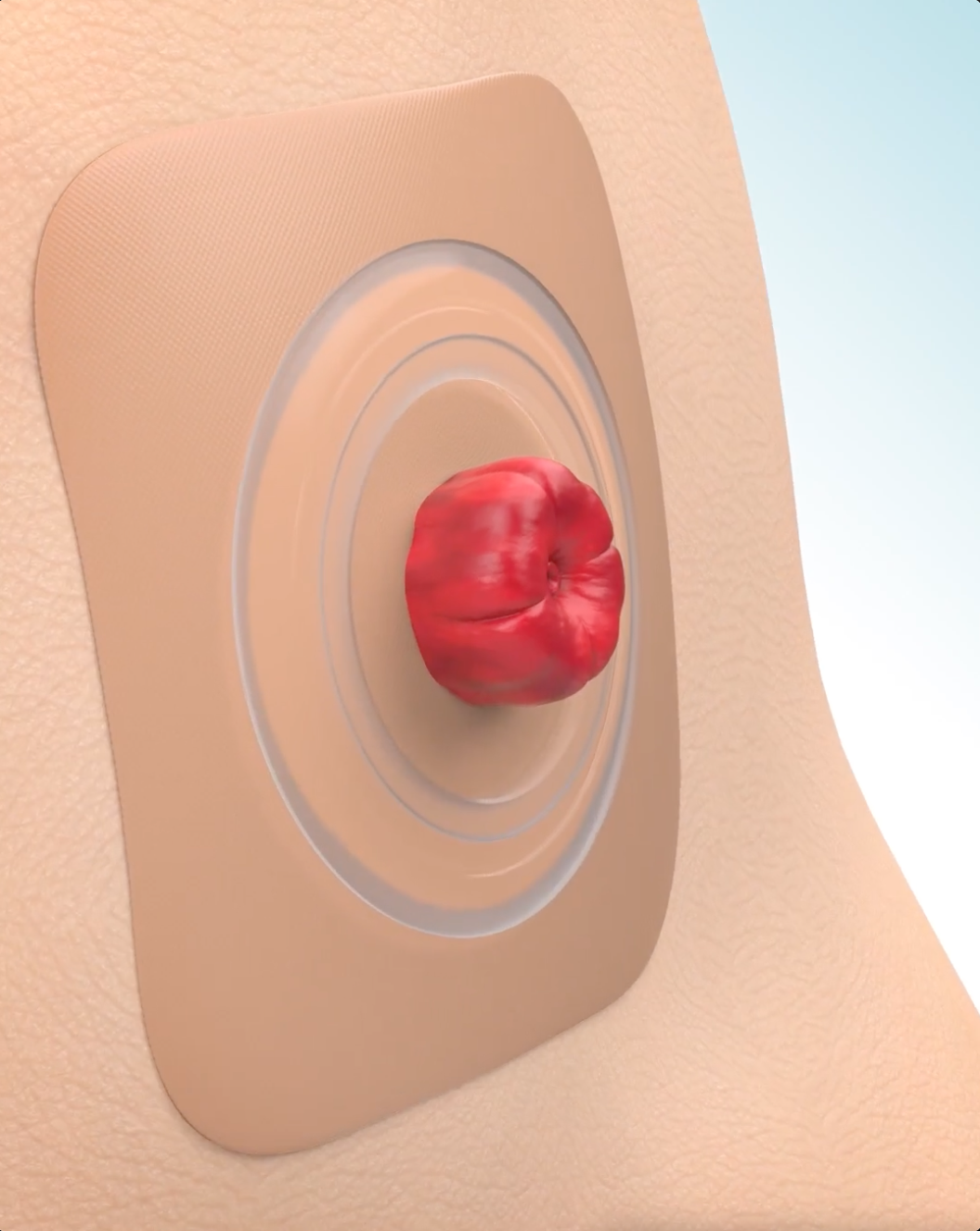 Video dimostrativo del funzionamento degli adesivi Convatec