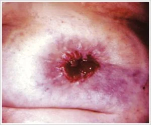 Eine Nahaufnahme der Haut einer Person mit rotem Ausschlag