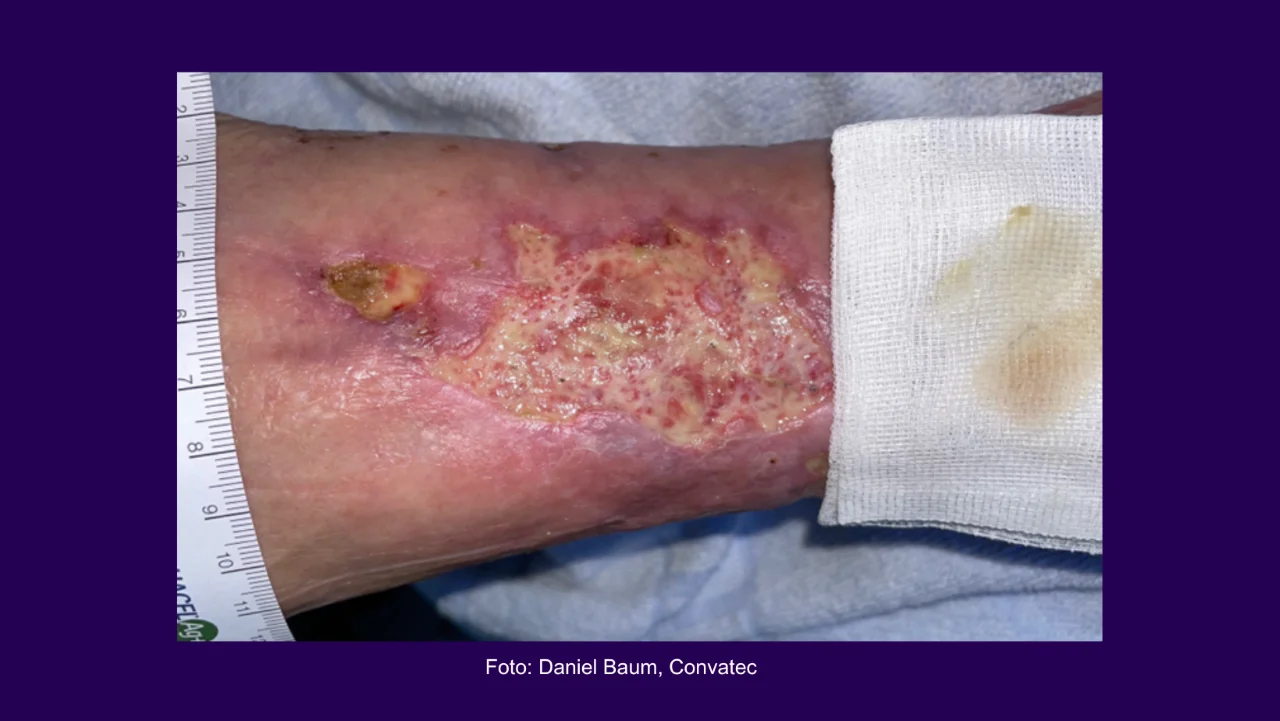 Welche Wundarten gibt es?