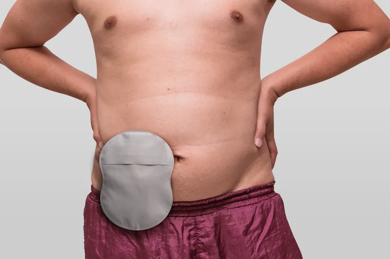 Man living with an ostomy showing his pouch