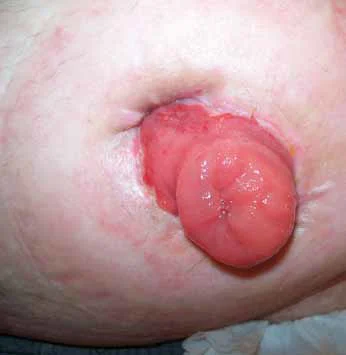 Zdjęcie obrzęku stomii