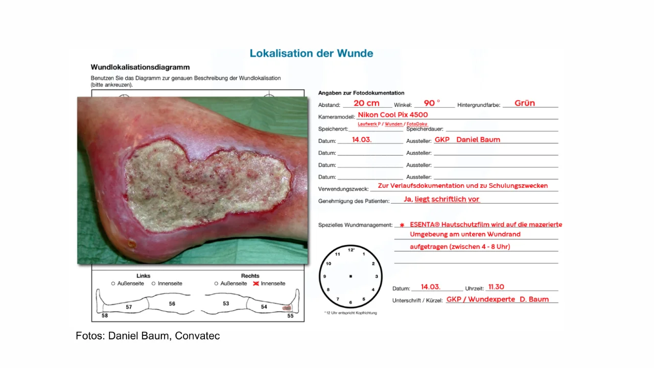 Wundddokumentation