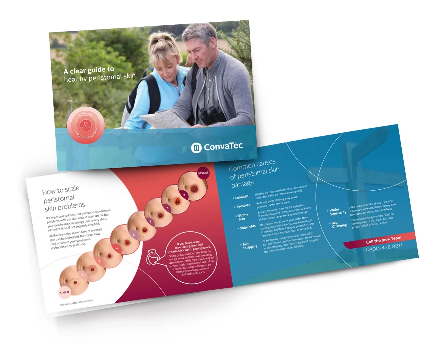 Ett omslag till broschyren: "Clear Guide to Healthy Peristomal Skin" fördjupar sig i fjällningsproblem och vanliga orsaker till hudskador.